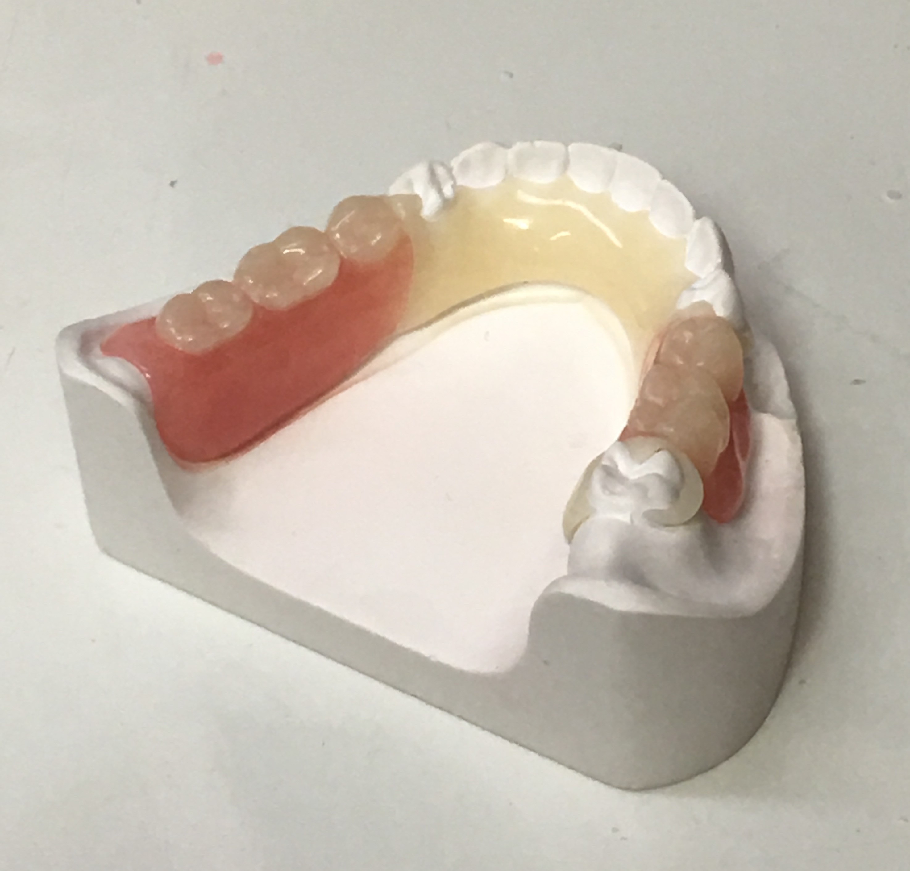 Removable Partial Dentures | Denture Lab 29412